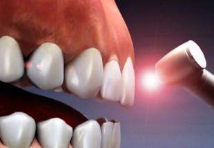 تشخیص به موقع حفره های دندانی با فناوری مادون قرمز