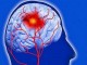 شایع ترین علائم سکته مغزی/زمان طلایی درمان حاد