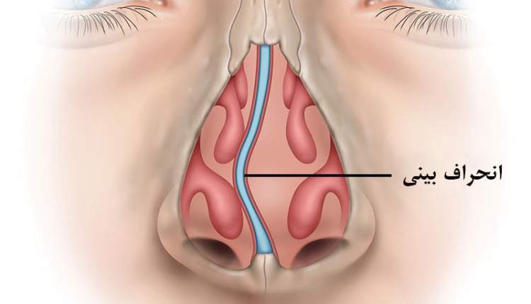 انحراف بینی با عمل قابل اصلاح است، پولیپ احتمال برگشت دارد