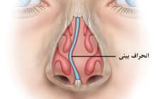 انحراف بینی با عمل قابل اصلاح است، پولیپ احتمال برگشت دارد