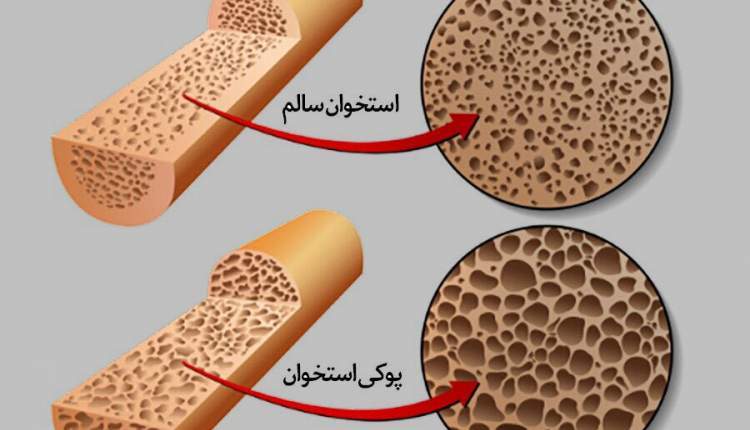 پوکی استخوان در چهارمحال و بختیاری شایع است